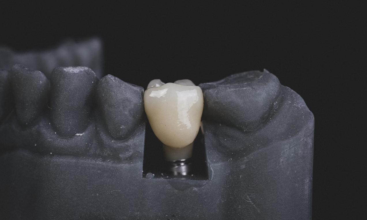Sveikų ir Gražių Dantų Atkūrimas: Visas Būtinas Informacija apie Dantų Protezavimą