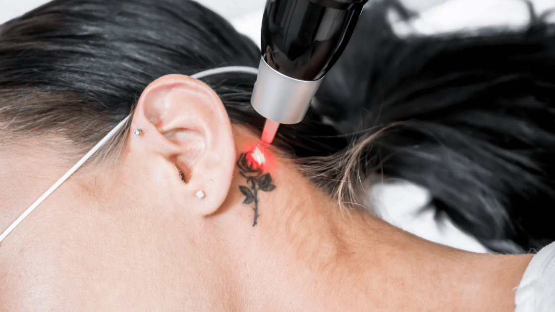 Pasiruošimas lazerinės tatuiruotės šalinimo seansui: Patarimai ir rekomendacijos
